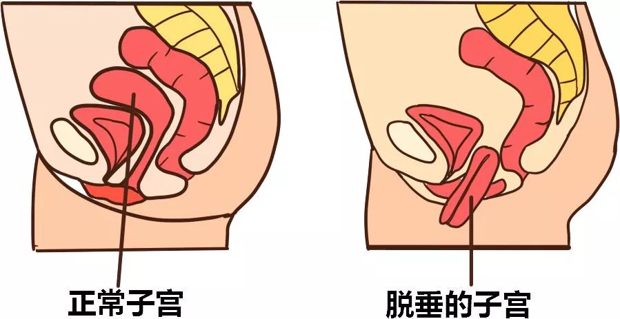 不敢出远门 常常与尿失禁相伴发生的是阴道前壁膨出 阴道会有异物感