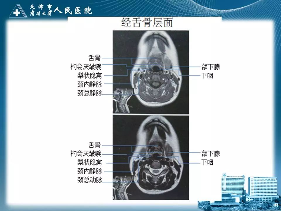 喉的应用解剖与影像解剖 | 影像天地