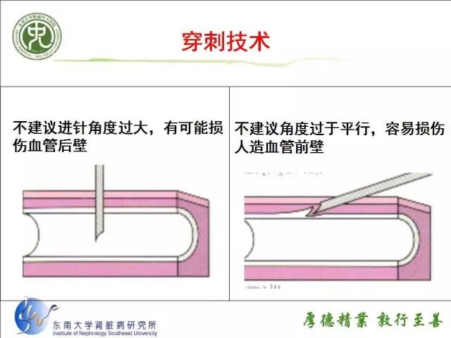 动静脉内瘘如何实施穿刺视频和ppt保你学会