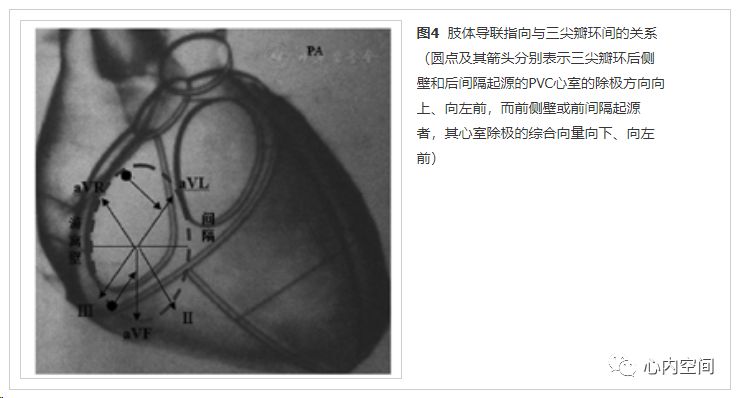 邻近三尖瓣环室性心律失常的心电图特征(下)