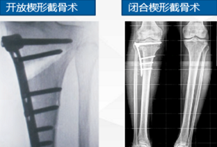 关于胫骨高位截骨(hto)小科普(原创)