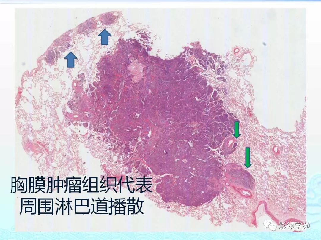 sclc中央区肿瘤组织,最初不在支气管.