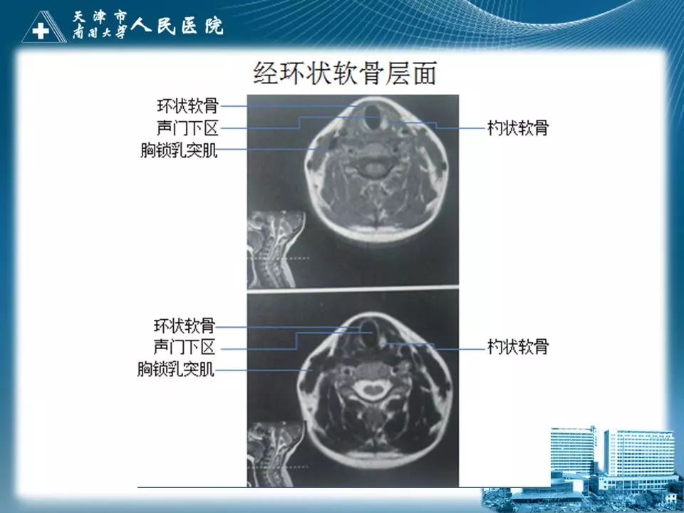 喉的应用解剖与影像解剖影像天地