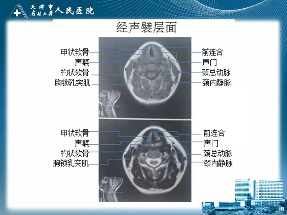 喉的应用解剖与影像解剖影像天地