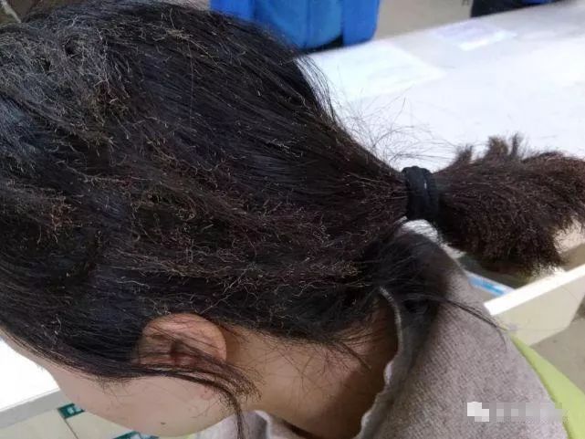 燃气爆炸 女子仅被烧到头发,这一举动救了她一命