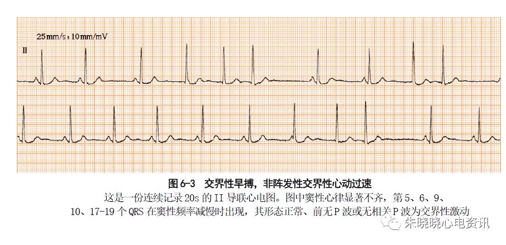 【张新民老师心电系列】第六讲:关于非阵发性心动过速