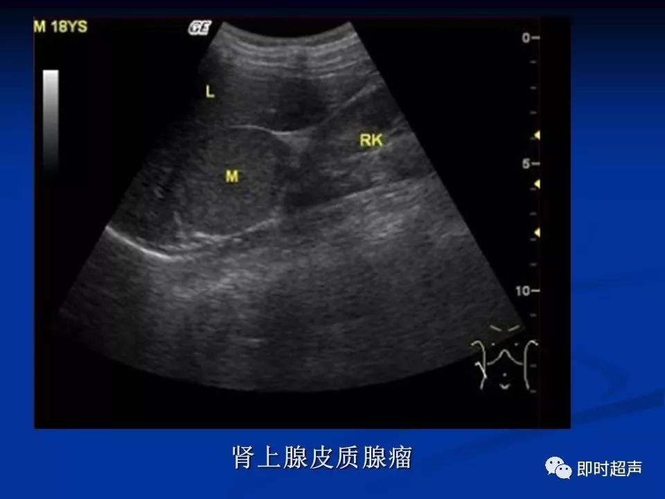 肾上腺疾病的超声诊断
