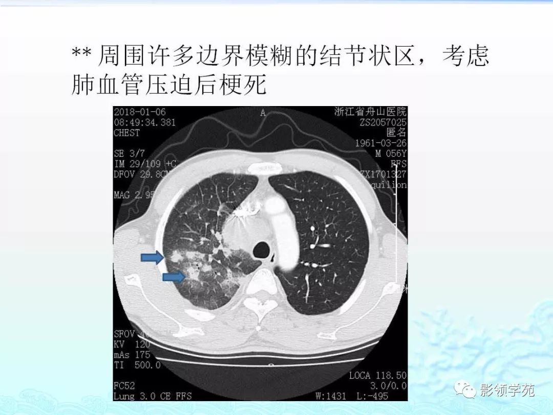 经典小细胞肺癌的病理影像分析