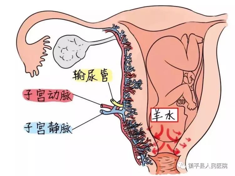 如胎盘附着处或其附近胎膜破裂,羊水有可能通过此裂隙进入母体子宫