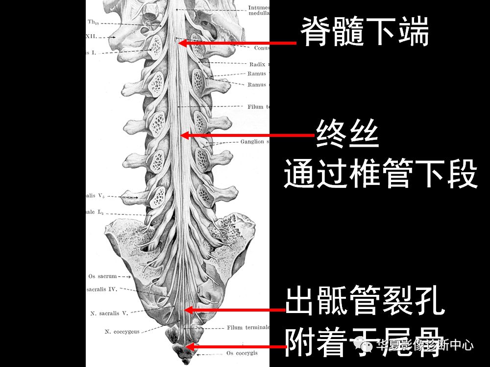 椎管内病变的精确定位