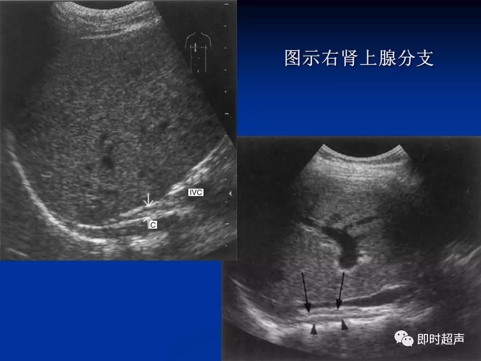 肾上腺疾病的超声诊断