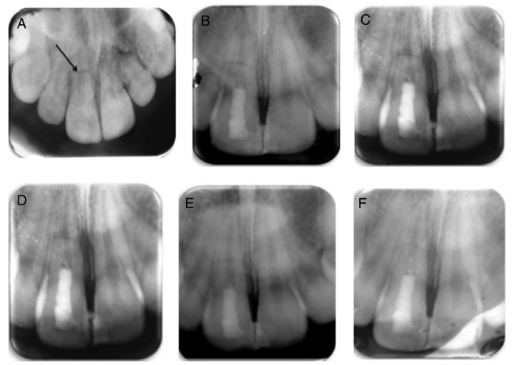 本文出处:微信公众号--江苏牙体牙髓 a术前片;b术后即刻;c术后5个