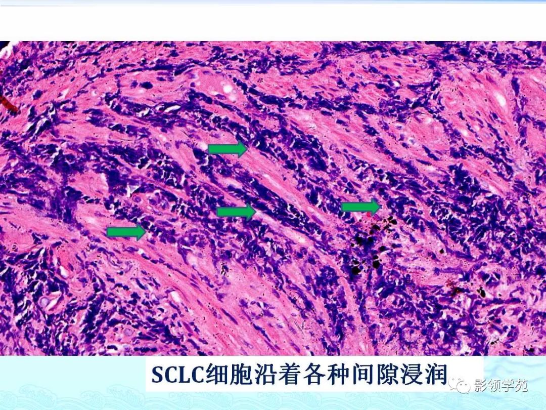 【经典】小细胞肺癌的病理影像分析_淋巴