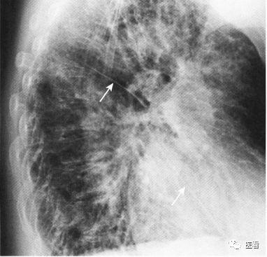 侧位胸片如何快速看这5大关键区域一定要记清医学影像每日笔记52