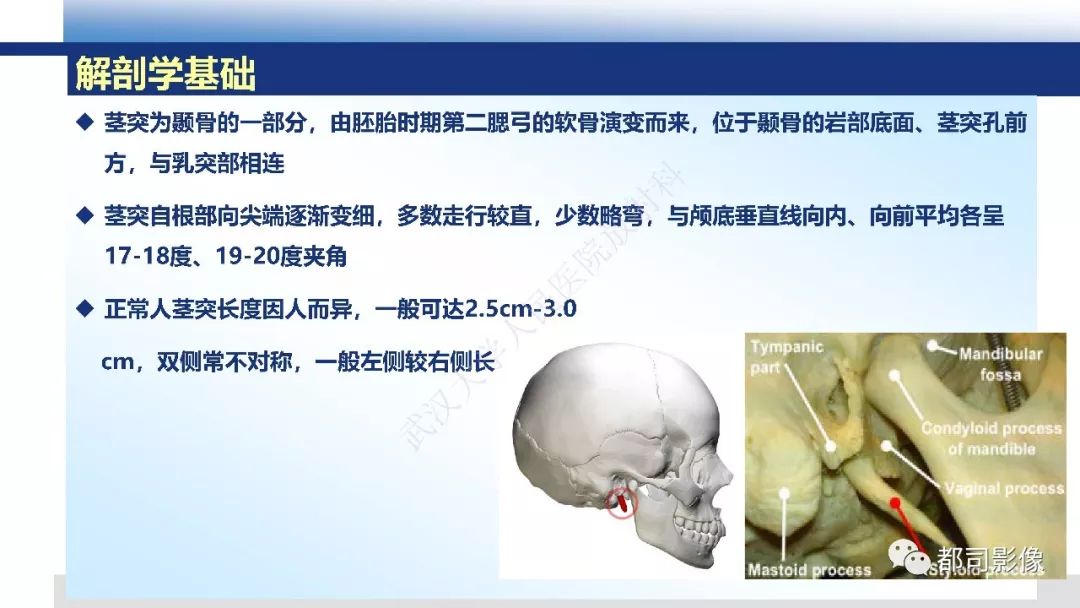 茎突综合征影像诊断