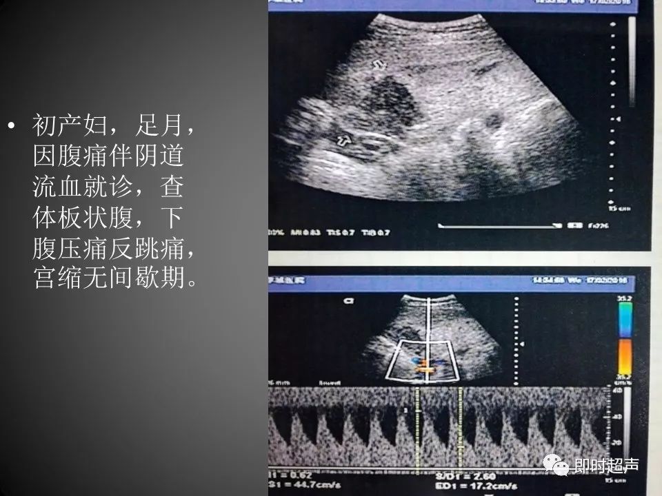 胎盘早剥的超声诊断