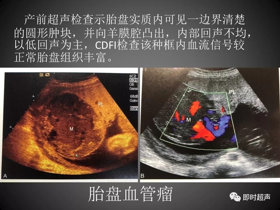 胎盘早剥的超声诊断