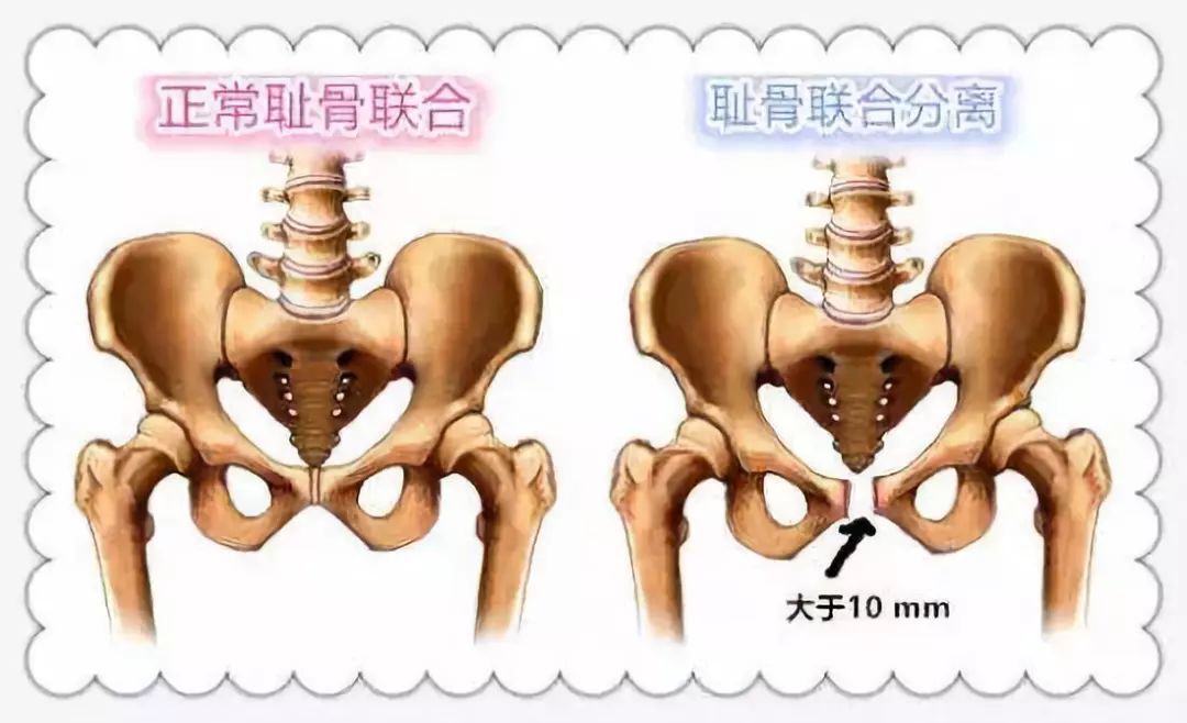 孕期最难熬的耻骨痛只有经历过的孕妇才知道痛起来真要命