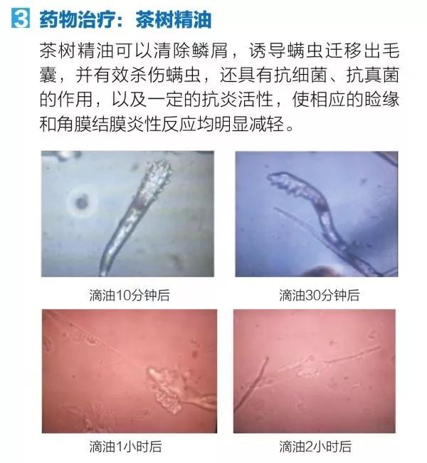 糟糕!干眼的又一元凶出现了——螨虫