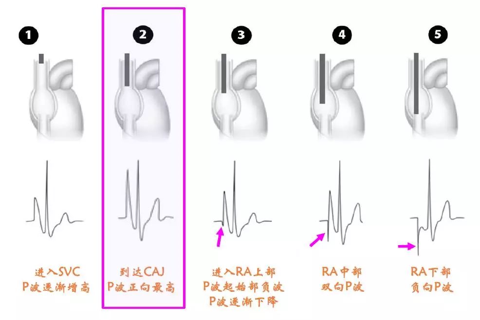 picc置管中腔内心电图p波形态改变及临床意义的研究[j].