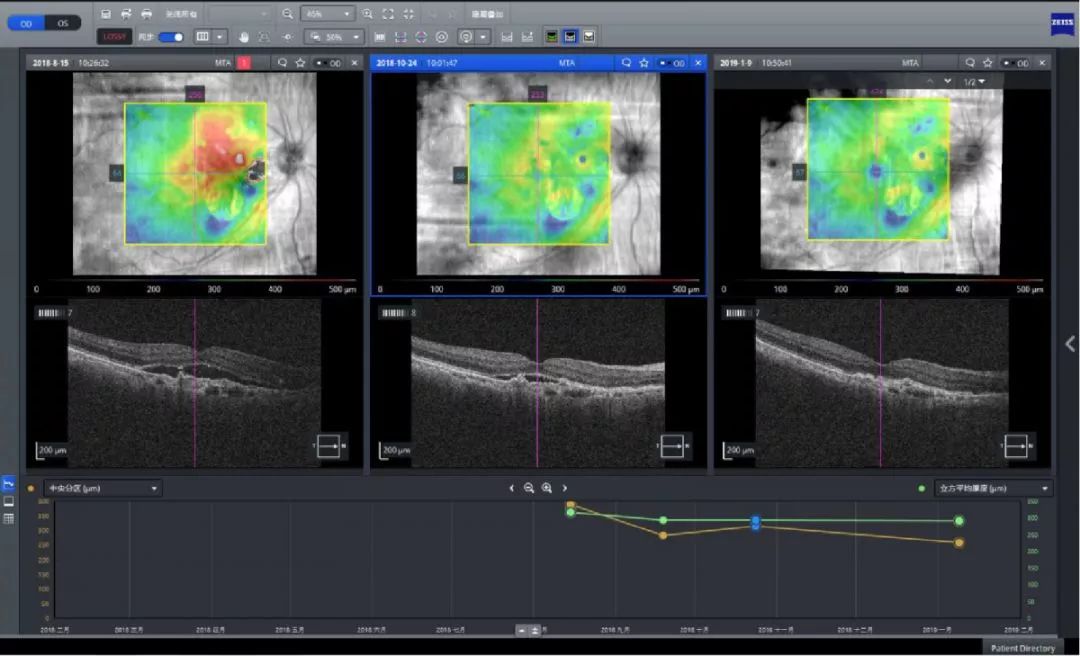 眼底病工作平台-黄斑厚度分析