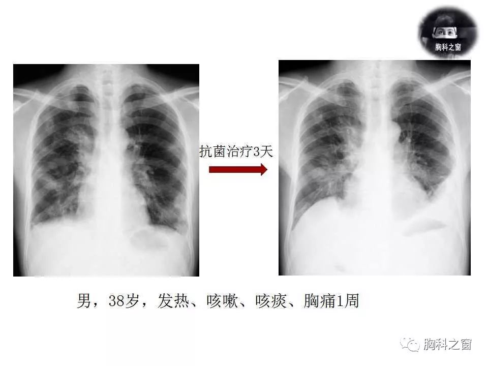 金黄色葡萄球菌肺炎的影像学表现