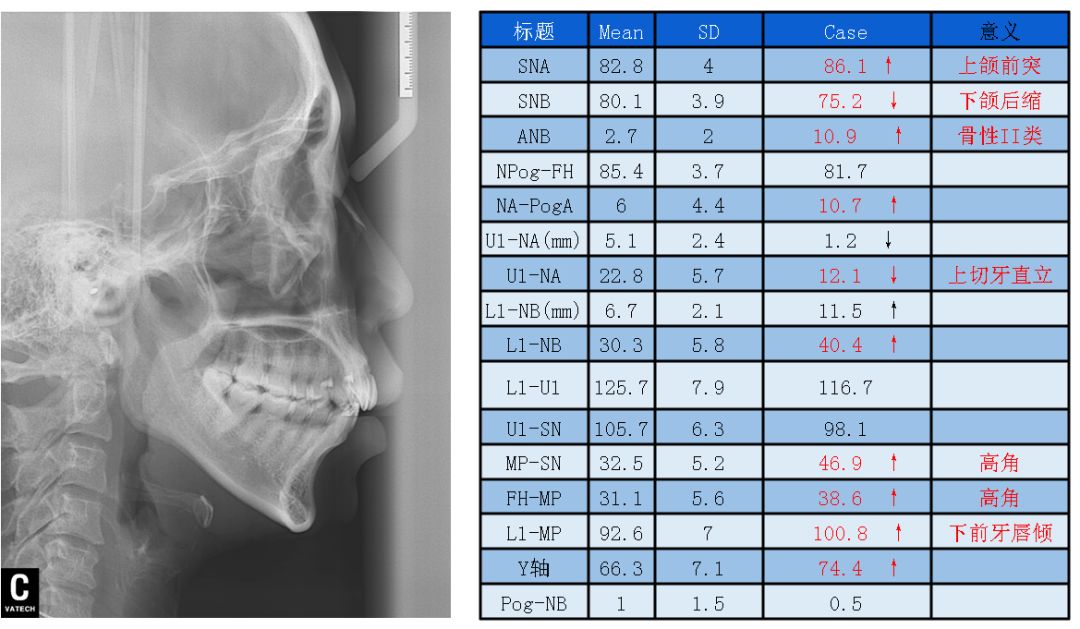 治疗前头影测量分析