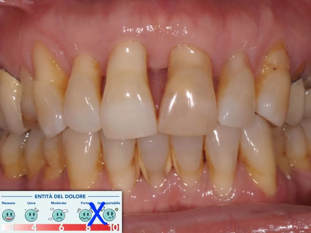 【牙医学堂】牙本质过敏症——一个被低估的问题