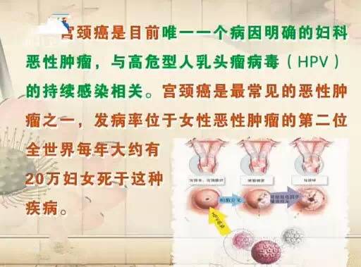 hpv感染与宫颈癌的关系最初在20世纪70年代提出,此后许多流行病学和