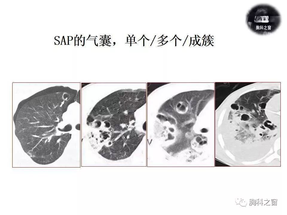 金黄色葡萄球菌肺炎的影像学表现