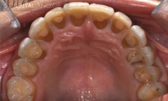 【牙医学堂】牙本质过敏症——一个被低估的问题