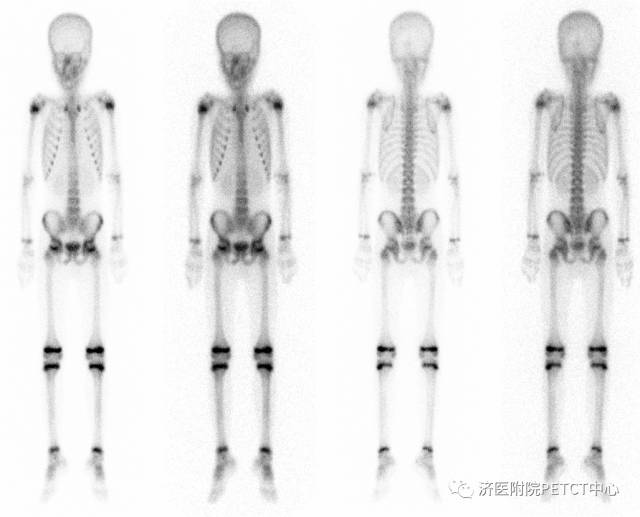 【收藏】pet/ct在骨骼系统方面临床应用