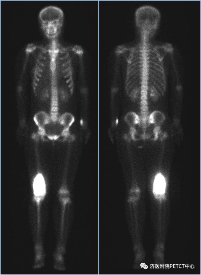 【收藏】pet/ct在骨骼系统方面临床应用