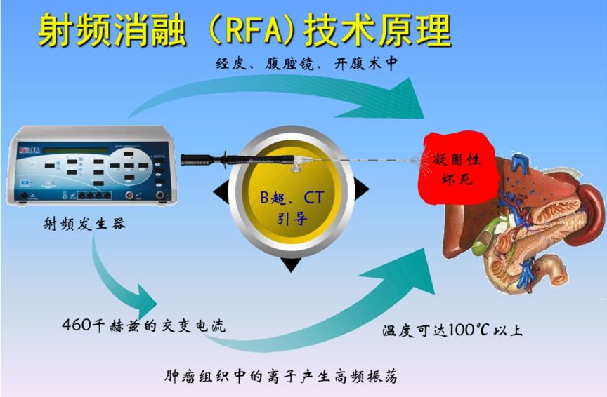 射频消融是热消融最常用的一种手段.