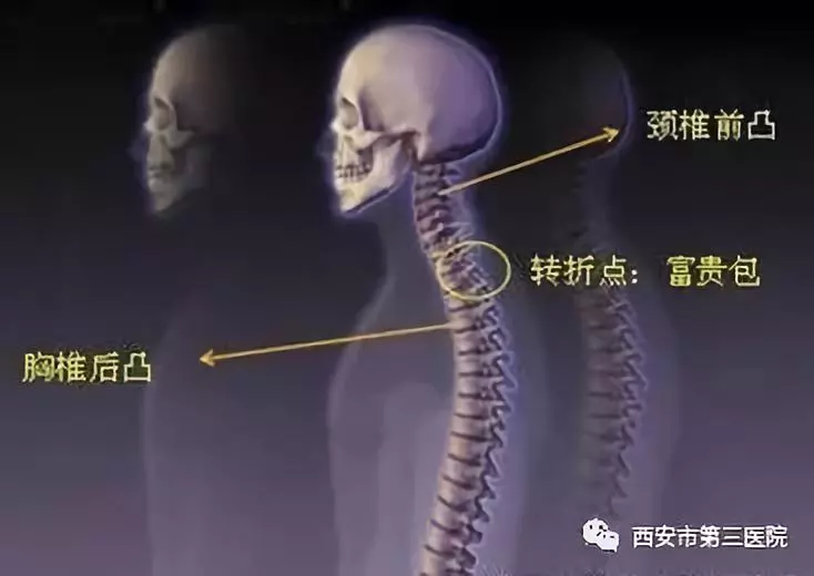 当颈椎下段过度前凸而胸椎上段过度后凸时,就形成了骨性的颈胸交界