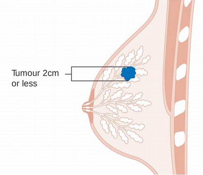 乳腺科医生常提到的"囊肿"严重吗_手术