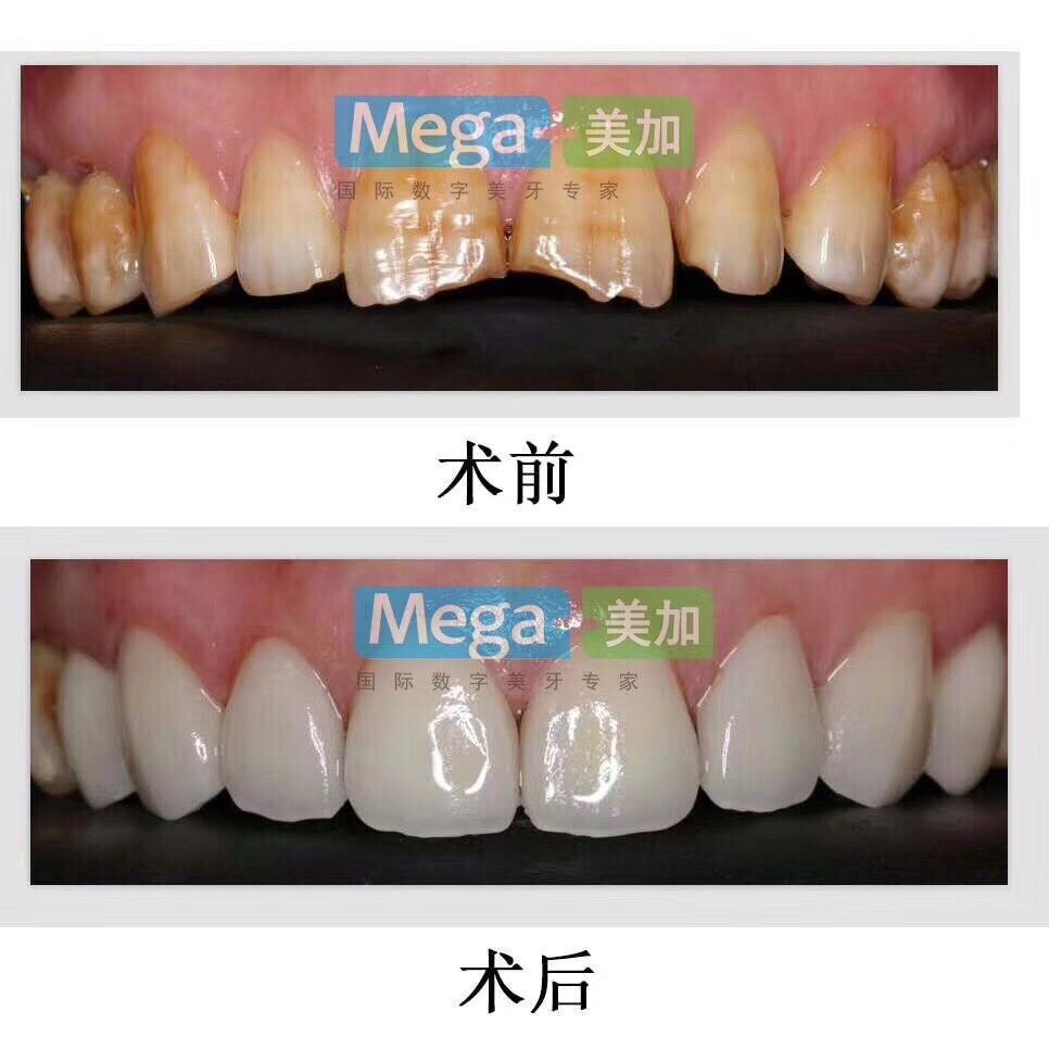 氟斑牙人口_氟斑牙图片