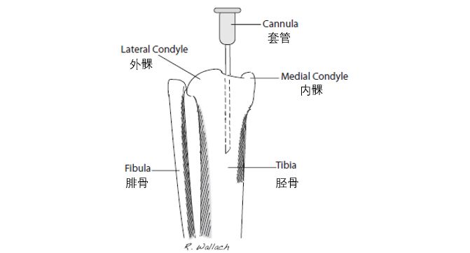 什么是骨髓腔输液