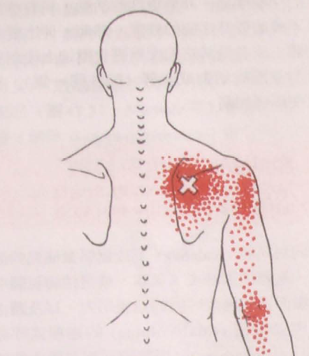 肩胛骨内侧缘疼痛的治疗