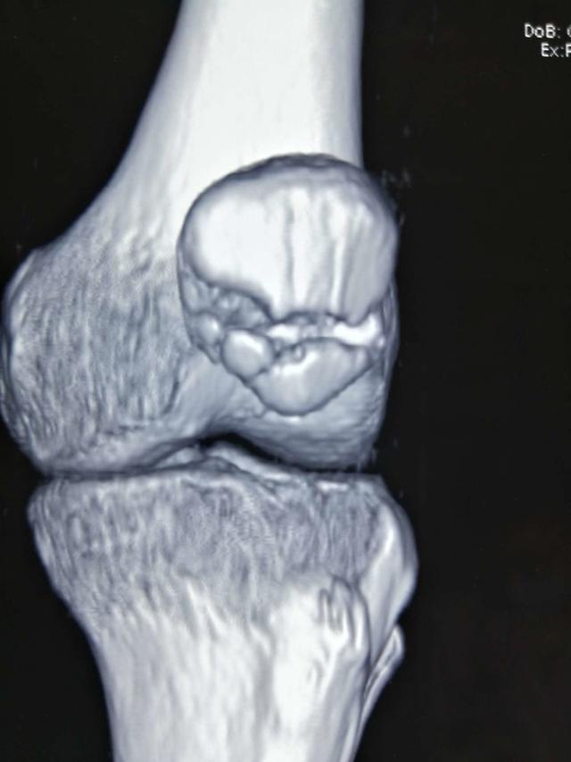 髌骨为人体最大的籽骨,骨折发生率约占全身所有骨折的1.