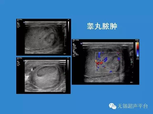 睾丸恶性肿瘤的超声诊断