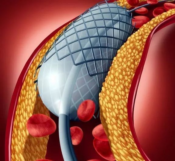 冠状动脉内支架植入术