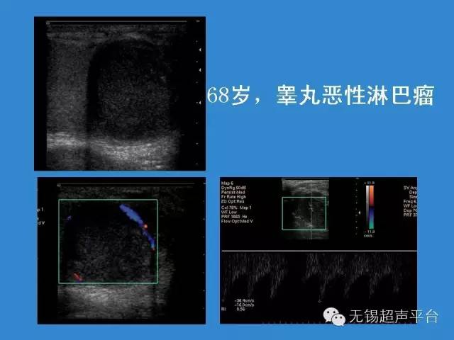 睾丸恶性肿瘤的超声诊断