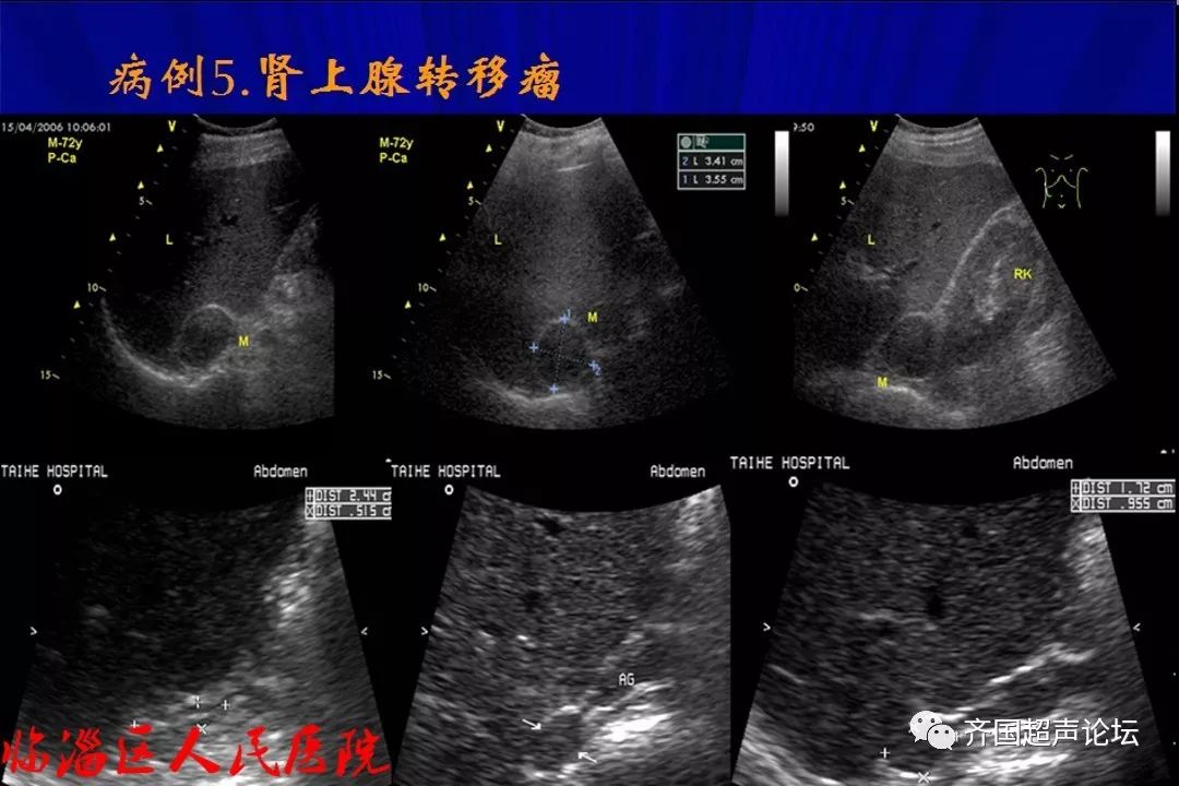 基础肾上腺正常声像图及常见疾病超声表现