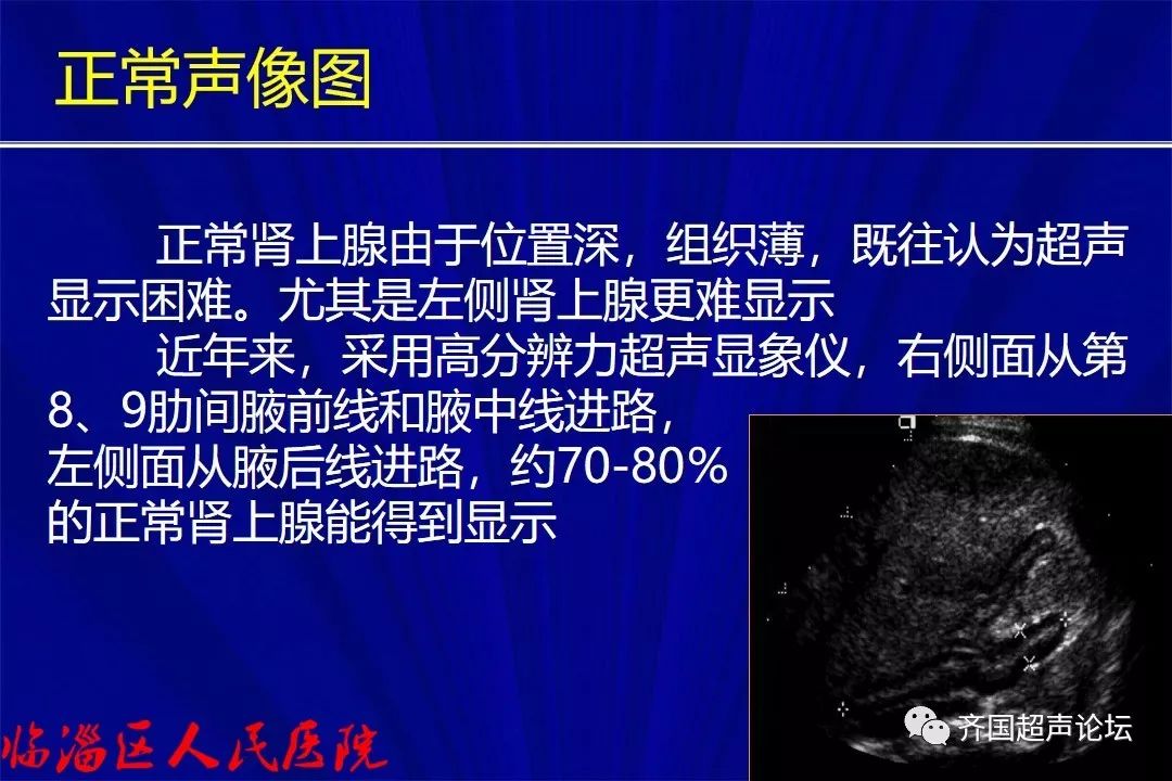 【基础】肾上腺正常声像图及常见疾病超声表现