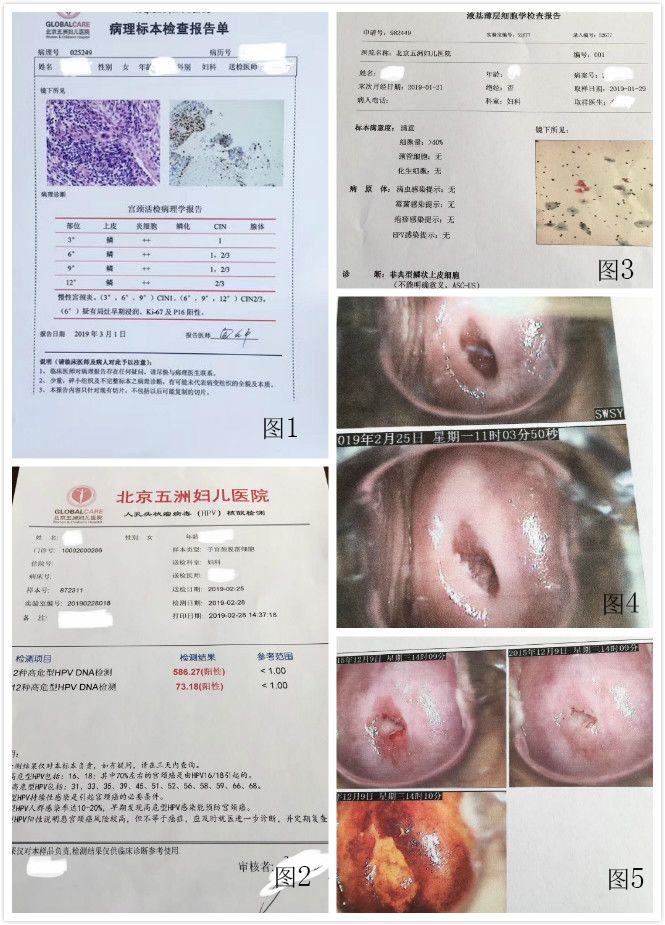 北京十里河医院妇科专家李蔚范宫颈癌的hpv感染不可小觑