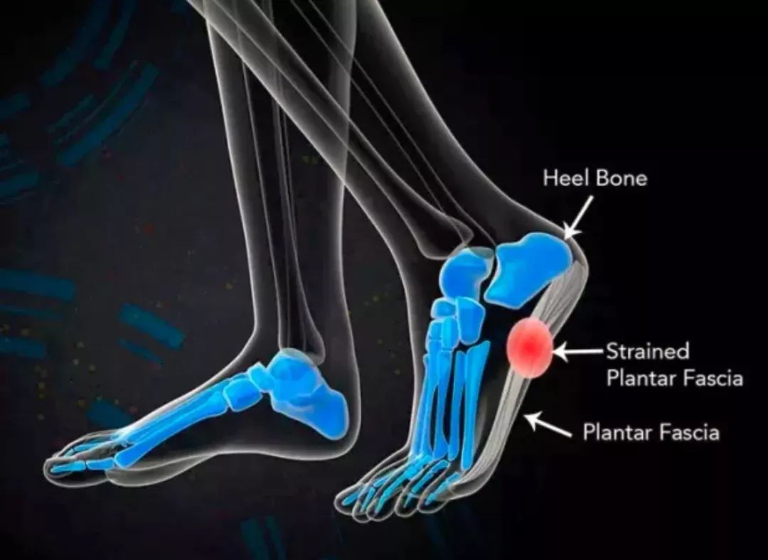 足底、足跟疼痛相关激痛点及穴位 - 知乎