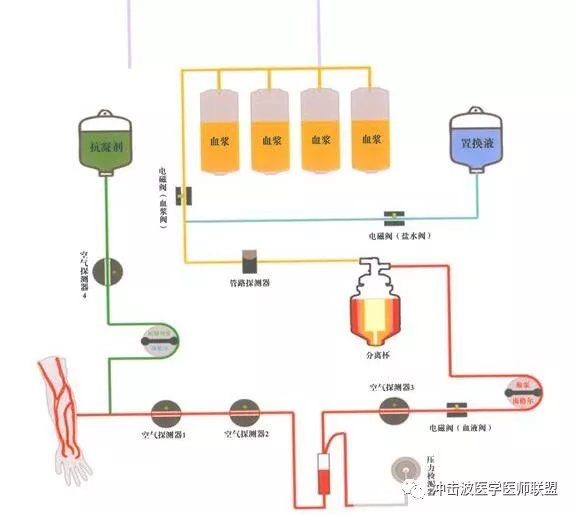 治疗性血浆置换术tpe治疗风湿疾病新技术_吸附