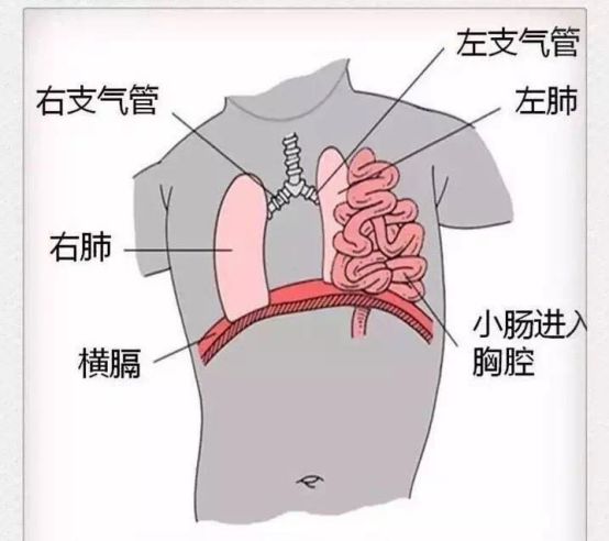 唐山健康①惊宝宝内脏肠子跑到左胸腔②通宵吃鸡要小心当心突聋找上你