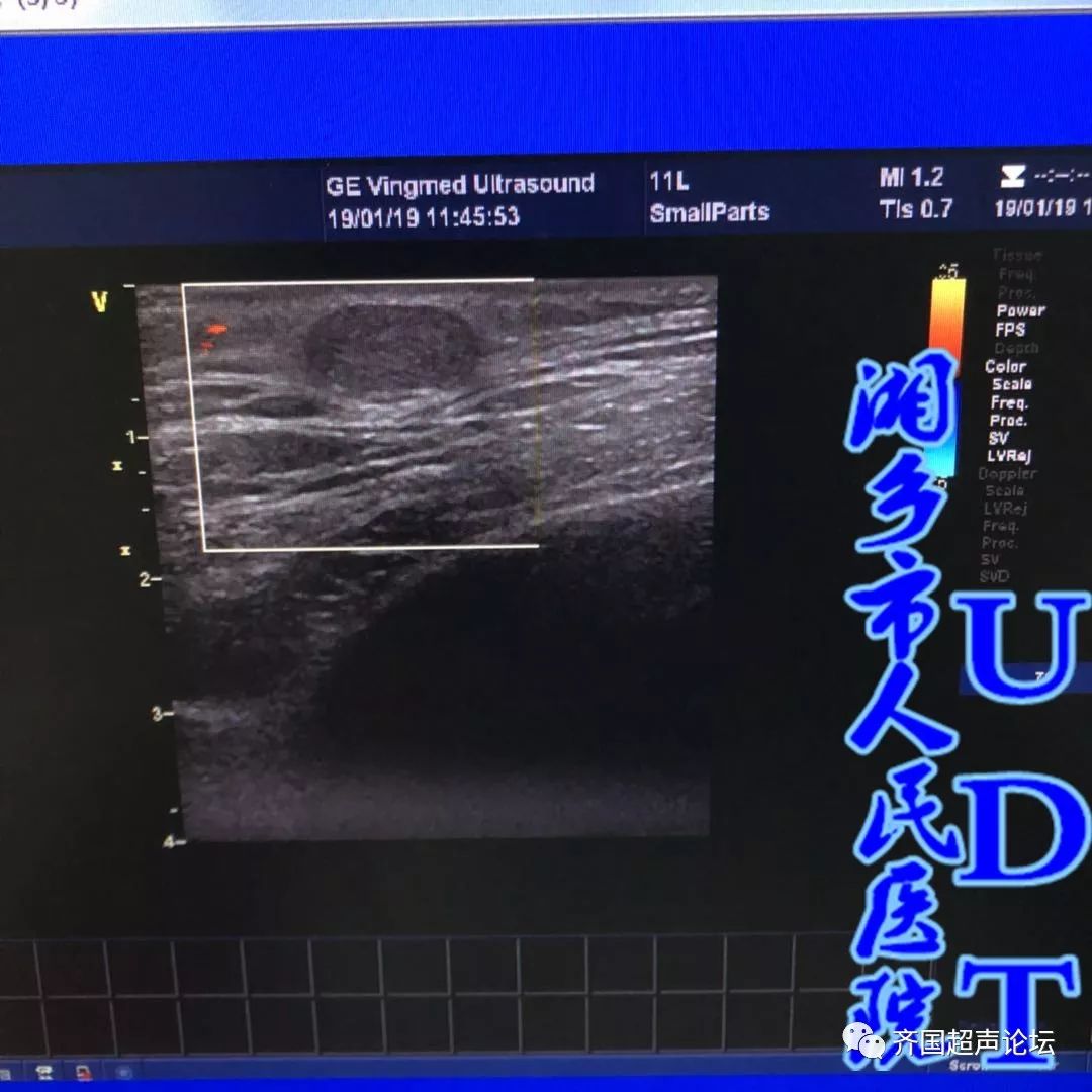 毛母质瘤udt病例543